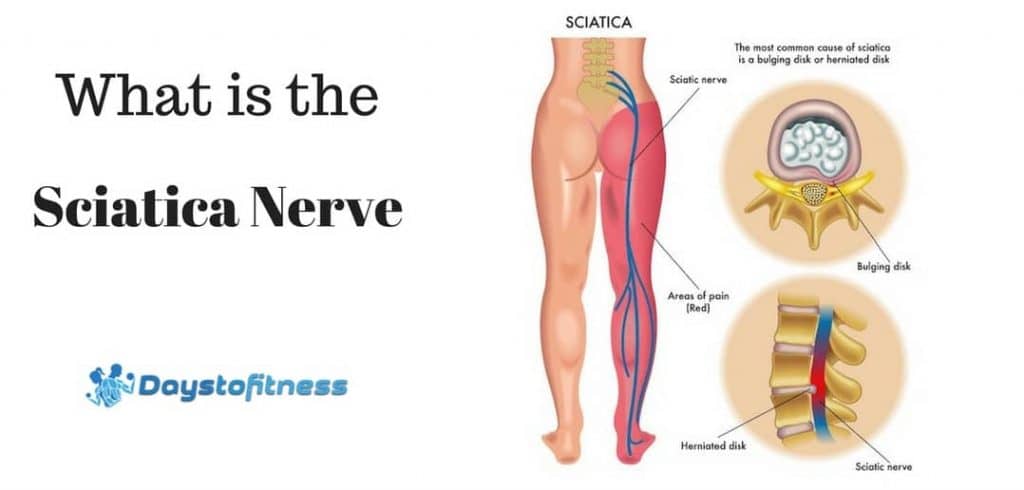 What is sciatica nerve post cover