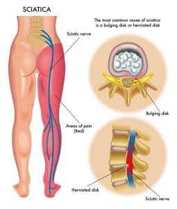 sciatica nerve anatomy